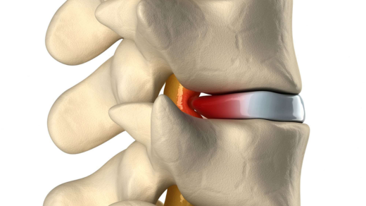 disc bulge treatment